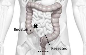 Ultra-low Anterior Resection